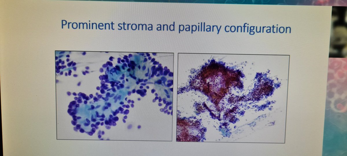 mdlozanoe's tweet photo. How many times did you make a cytological diagnosis of Pneumocytoma???👀👀🥺🥺. @mtsiddi gives us valuable guidelines for dealing with this entity 🙌👏👏#ECC2021Wroclaw https://t.co/oCzUaU8TXw
