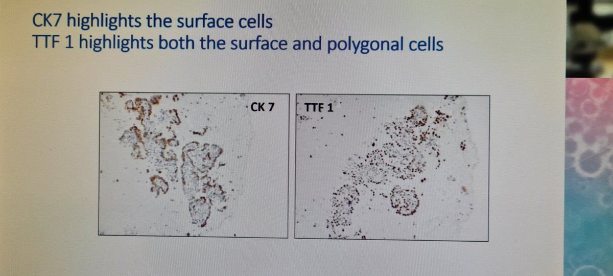 mdlozanoe's tweet photo. How many times did you make a cytological diagnosis of Pneumocytoma???👀👀🥺🥺. @mtsiddi gives us valuable guidelines for dealing with this entity 🙌👏👏#ECC2021Wroclaw https://t.co/oCzUaU8TXw