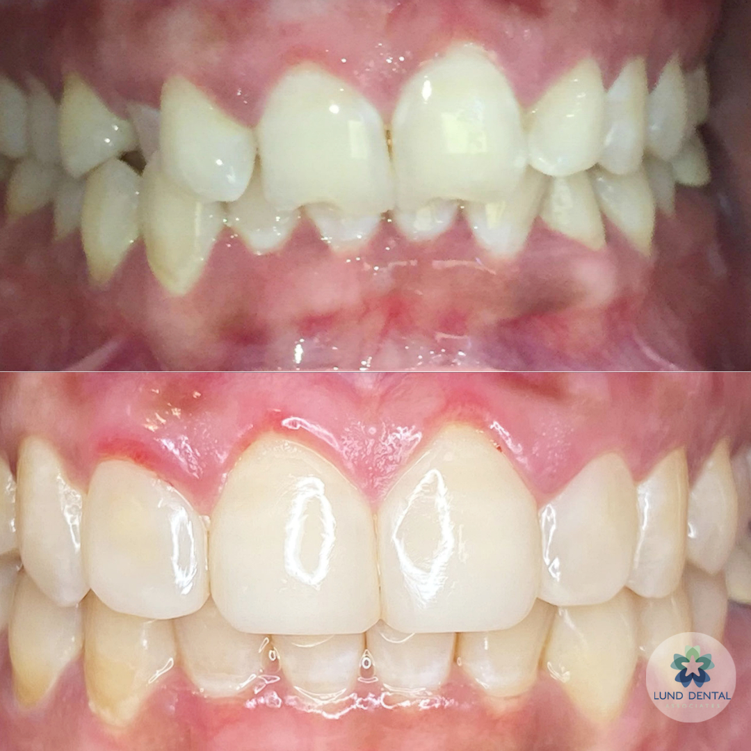 LundDental's tweet image. Invisalign and Bioclear - 8 months. 34 years old. Changing lives and rejuvenating smiles.  
#bioclear #iTero #bioclearmethod #beforeandafter #stonehamma #dentist #dentaloffice #yourhealth #lunddental #showusyoursmile #familydentist #woburnma #wakefieldma #readingma #bestdentist