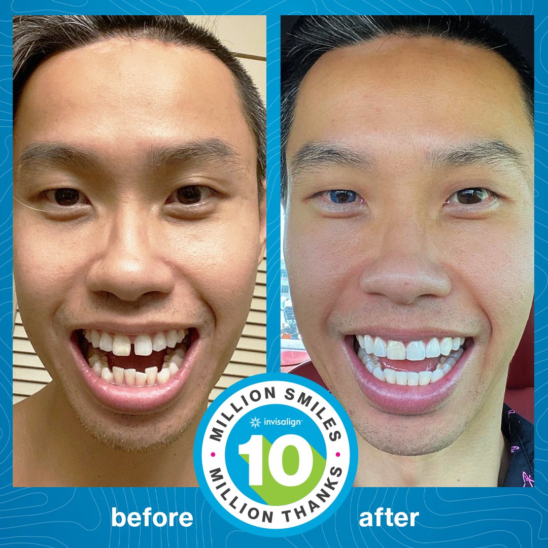 Invisalign's tweet image. It’s #TransformationTuesday! Check out these Invisalign treatment results from📷Sunny.ckh. 😃👍

#invisalign #invisalignsmile