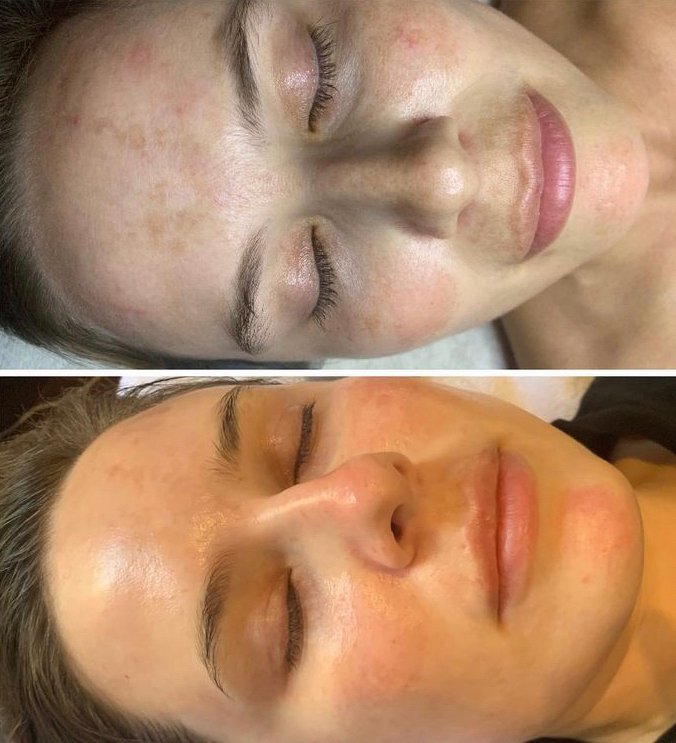 VivantSkinCare's tweet photo. It’s amazing what the right #skincareroutine boosted by professional treatments @kimberlymillerskin can achieve in four months. Next, fine-tuning with peels and microneedling paired with targeted serums like True Tone and 8% Mandelic Acid. Find your #eventon... https://t.co/jJdiHhmYwc