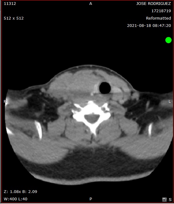 AurysVille's tweet photo. Mi esposo fue diagnosticado con un Tumor Cancerígeno en la Tiroides, el cual está creciendo cada día, ha desplazado y aprisionado su tráquea de tal forma que se le está haciendo difícil comer, tragar y a veces respirar.  Necesita ser operado con URGENCIA en 2 semanas más tardar. https://t.co/NO7LNtTAX6