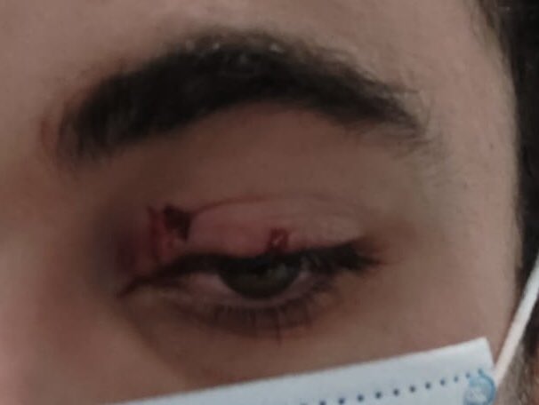 _JoanRibera's tweet photo. Bon dia @comuee , comentar-vos que l’estat deplorable de les pistes de basquet de Sa Calma ha causat una important ferida al ull del meu germà. Aquesta matinada l’han hagut de operar a l’hospital de la Vall d’Hebron. https://t.co/BzbX7b61eu