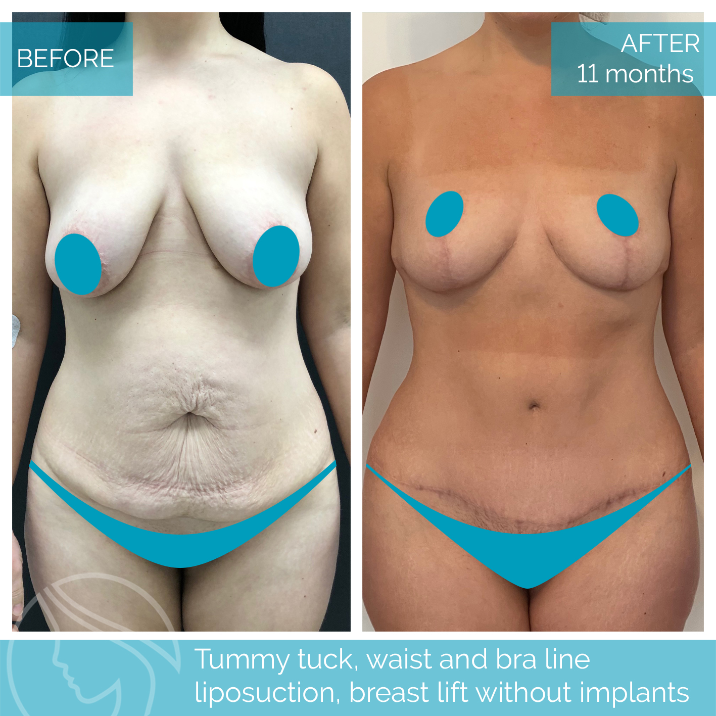 Nordesthetics Clinic on X: Patient had a #tummytuck, waist and bra line # liposuction with #breastlift. These are significant procedures, and while  the results are thrilling, we want to remind you that there