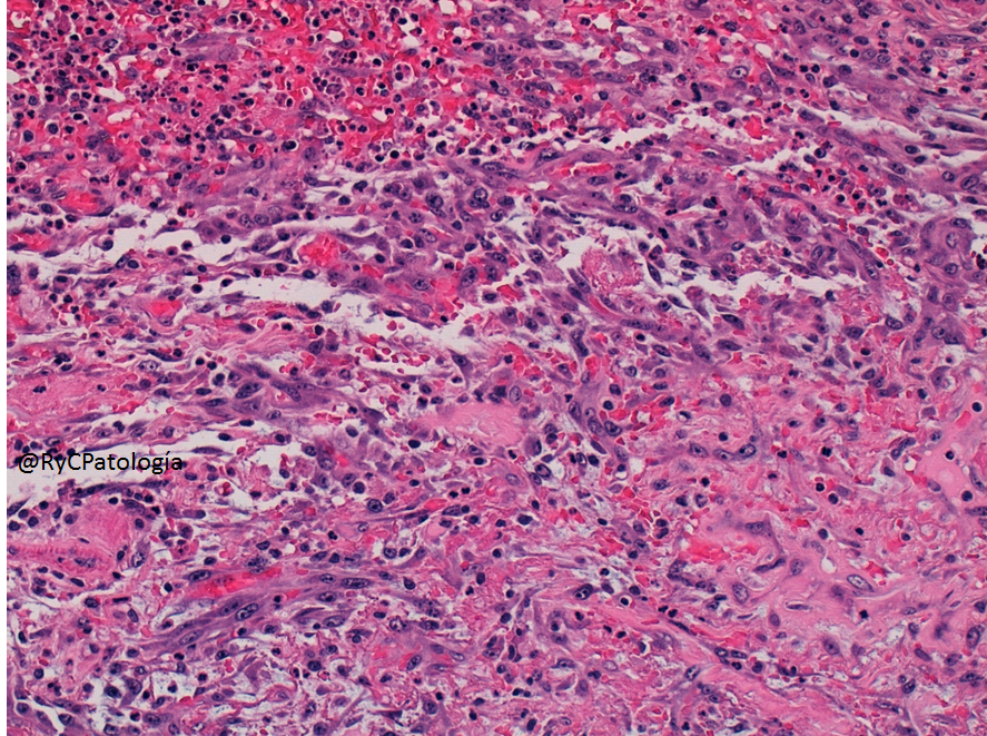 RyCPatologia's tweet photo. ➡️ Obstrucción intestinal.
➡️ Resección segmentaria.
🔬 Inmunohistoquímica: CD31 y Ki67.

☑️ Angiosarcoma intestinal primario. https://t.co/aUvuo53yRe
