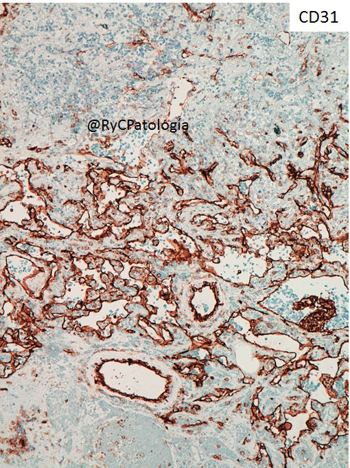 RyCPatologia's tweet photo. ➡️ Obstrucción intestinal.
➡️ Resección segmentaria.
🔬 Inmunohistoquímica: CD31 y Ki67.

☑️ Angiosarcoma intestinal primario. https://t.co/aUvuo53yRe