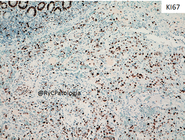 RyCPatologia's tweet photo. ➡️ Obstrucción intestinal.
➡️ Resección segmentaria.
🔬 Inmunohistoquímica: CD31 y Ki67.

☑️ Angiosarcoma intestinal primario. https://t.co/aUvuo53yRe