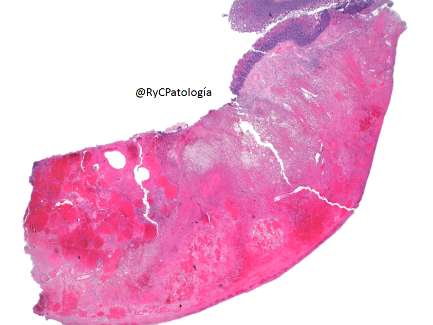 RyCPatologia's tweet photo. ➡️ Obstrucción intestinal.
➡️ Resección segmentaria.
🔬 Inmunohistoquímica: CD31 y Ki67.

☑️ Angiosarcoma intestinal primario. https://t.co/aUvuo53yRe