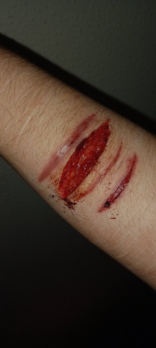 BeanFarmer5's tweet photo. SGTWT NEW PICS|| Because of where I was cutting it wasn't gaping at all. Barely gaping now but it's better that it was last night. Fascia and shit.|| #beanstwt #shtwt #selfharm #shpics #madeofbeans #sliceytwt #redbreadtwt #barcodetwt #ouchytwt #selfharmtwt https://t.co/3nU4SEtHfA