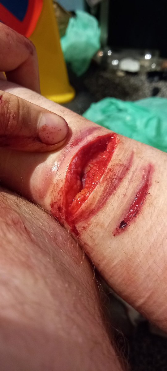 BeanFarmer5's tweet photo. SGTWT NEW PICS|| Because of where I was cutting it wasn't gaping at all. Barely gaping now but it's better that it was last night. Fascia and shit.|| #beanstwt #shtwt #selfharm #shpics #madeofbeans #sliceytwt #redbreadtwt #barcodetwt #ouchytwt #selfharmtwt https://t.co/3nU4SEtHfA