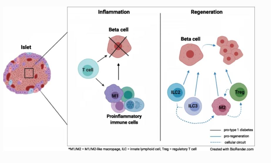 Diabetologia (@diabetologiajnl) on Twitter photo This review discusses the potential for immunoregulatory macrophages, innate lymphoid cells and regulatory T cells to promote beta cell regeneration in #type1diabetes <a href="/mklevings/">Megan Levings</a>, <a href="/BruceVerchere/">Bruce Verchere</a>, @sarah_crome, <a href="/MahdisMonajemi/">Mahdis Monajemi</a>, <a href="/Colpitts_sarah/">Sarah Colpitts</a>, <a href="/mbudd177/">Matt B</a> bit.ly/3zxxMBD This review discusses the potential for immunoregulatory macrophages, innate lymphoid cells and regulatory T cells to promote beta cell regeneration in #type1diabetes <a href="/mklevings/">Megan Levings</a>, <a href="/BruceVerchere/">Bruce Verchere</a>, @sarah_crome, <a href="/MahdisMonajemi/">Mahdis Monajemi</a>, <a href="/Colpitts_sarah/">Sarah Colpitts</a>, <a href="/mbudd177/">Matt B</a> bit.ly/3zxxMBD