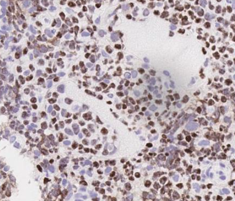 SibaElHussein's tweet photo. #LessonsfromtheFridayUnknowns High grade DLBCL with an intravascular component by 
@ljmedeirosMD➡️ https://t.co/cHIlPl8tjO
Lymphomas with intravascular pattern shared by @hemepathguy :
Intravascular LBCL;HSTCL;TLGLL;NK/T cell lymphoma;SMZL;some PTCL &amp; DLBCL #hemepath #PathTwitter https://t.co/MDIqXEsdoC