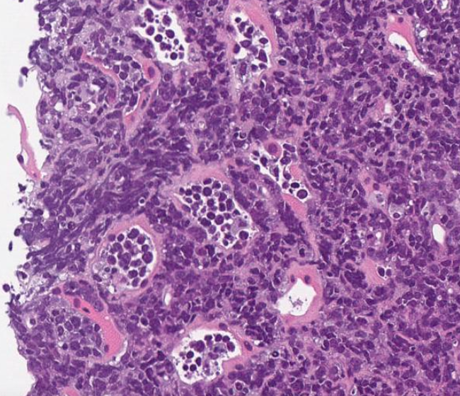 SibaElHussein's tweet photo. #LessonsfromtheFridayUnknowns High grade DLBCL with an intravascular component by 
@ljmedeirosMD➡️ https://t.co/cHIlPl8tjO
Lymphomas with intravascular pattern shared by @hemepathguy :
Intravascular LBCL;HSTCL;TLGLL;NK/T cell lymphoma;SMZL;some PTCL &amp; DLBCL #hemepath #PathTwitter https://t.co/MDIqXEsdoC