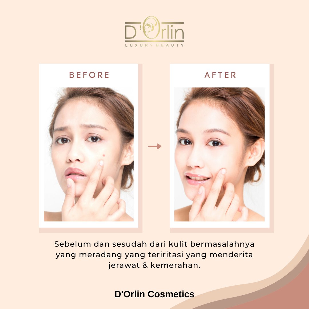 orlincosmetics's tweet photo. #bisnistanpamodal #agenkosmetik #testimoni #testishopee #entrepreneur #bisnishalal #bisnismurah #serumglowing #serumkinclong #serumflekhitam #superglowing #glowingskincare #skincareglowing #skincarekinclong #skincareglowing #serumporibesar #serumpremium #agenkosmetik #testimoni https://t.co/2Lc47J6mHz
