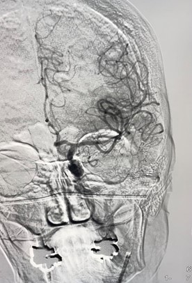 PenNeuro's tweet image. US HCPs: Dr. Ashish Nanda from @SSMHealth gets recanalization with #RED68. #RaisingTheStandard #REDglideDifference Rx only. For indications, contraindications, warnings, precautions &amp;amp; potential adverse events see bit.ly/2BYj7Yj Clinical results vary.
