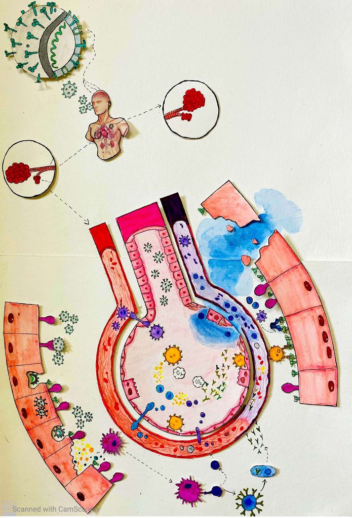 Mahek_3012's tweet photo. Today’s Prompt is circular! 

So here is throwback illustration depicting SARS-Cov -2 infection in the lungs, I have made for @dsgoodsell #cellspace

#SciArtSeptember #SciArt https://t.co/fdNeSmyQMx