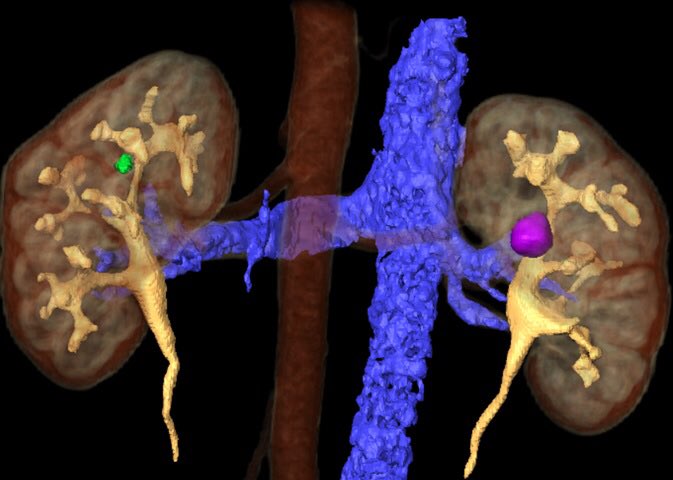 Dmitry_Enikeev's tweet photo. Perc Cryoablation of T1a intrarenal tumor with CT guidance. Thanks @olegraumann for tips and tricks. #localanaesthesia #outpatientprocedure @eauesut @barret_e @JGomezRivas https://t.co/ODkvFjCJAo
