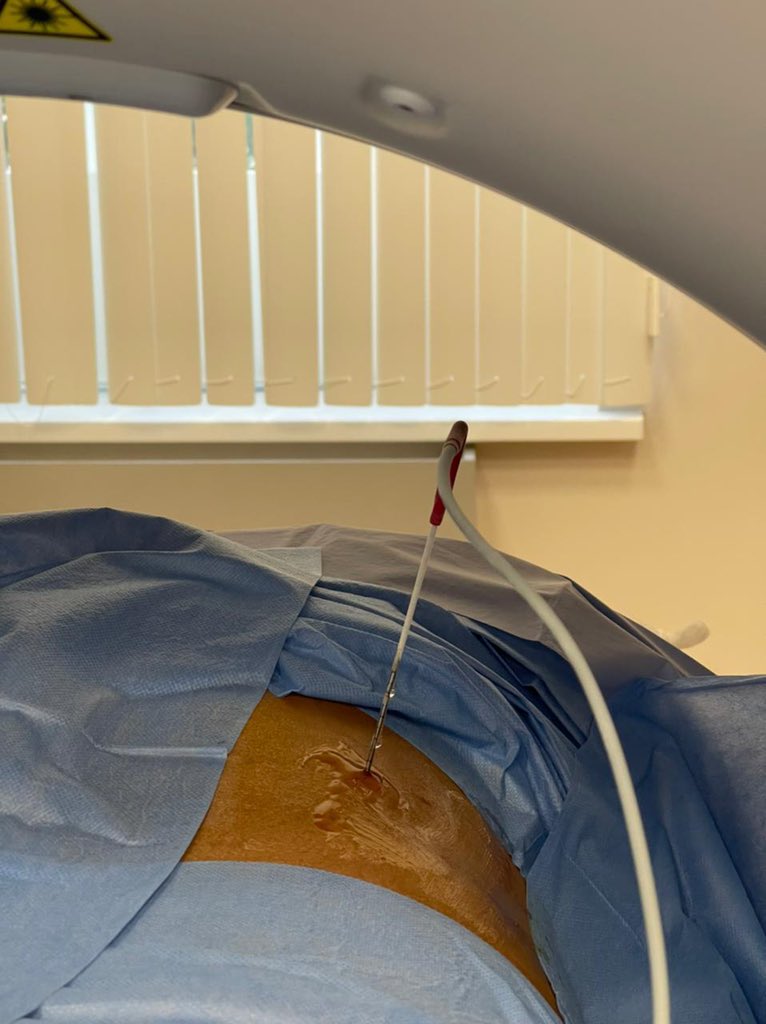 Dmitry_Enikeev's tweet photo. Perc Cryoablation of T1a intrarenal tumor with CT guidance. Thanks @olegraumann for tips and tricks. #localanaesthesia #outpatientprocedure @eauesut @barret_e @JGomezRivas https://t.co/ODkvFjCJAo