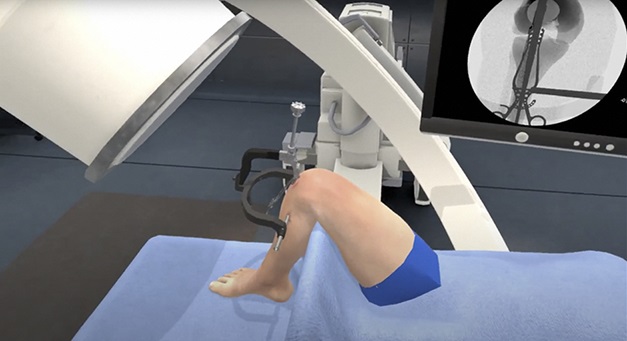 Clinorthop's tweet photo. #FreeinCORR Does virtual reality improve procedural completion and accuracy in an intramedullary tibial nail procedure? #OrthoTwitter #MedStudentTwitter #MedTwitter @UICOrthoRes @MarkOrland6 
https://t.co/EIdWIH88XN https://t.co/TvSQkgj2qI