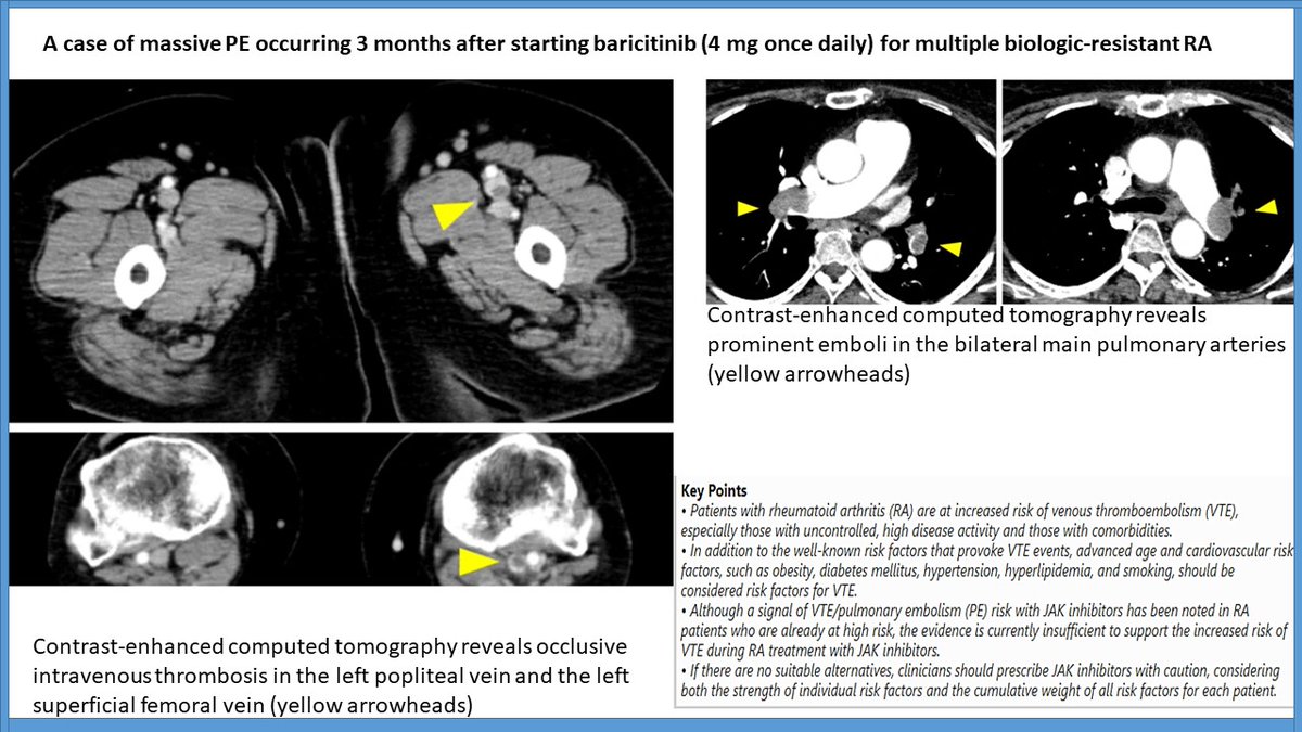 Does treatment with #JAKinhibitors increase risk of venous #thromboembolism  in RA patients?
👉rdcu.be/cynRz
#RheumatoidArthritis #RheumTwitter
