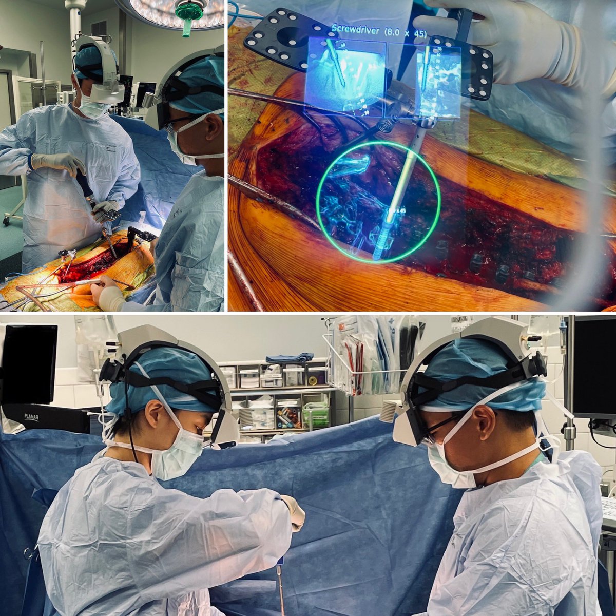 Excited to share we launched our #augmentedreality spine surgery program <a href="/MGHNeurosurg/">MGH Neurosurgery</a>, being first in Boston &amp; New England to offer this for our patients. Driving innovation in patient care, surgical training, education &amp; research. AR visualization is a game changer! <a href="/augmedics/">Augmedics</a>