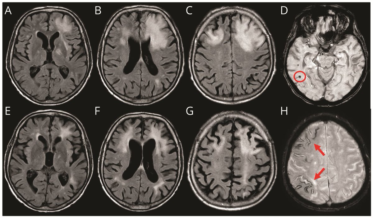 GreenJournal's tweet photo. Spontaneous ARIA-like Events in Cerebral Amyloid Angiopathy–Related Inflammation: A Multicenter Prospective Longitudinal Cohort Study https://t.co/VAqwcwRB5A #alzheimer #neurotwitter https://t.co/3DwjFWviIm