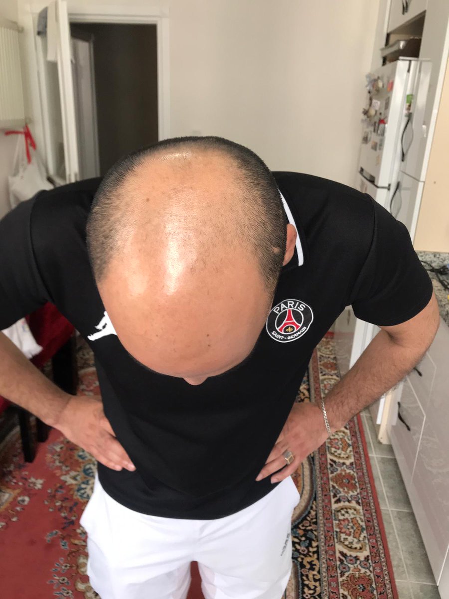 DegisimMucize's tweet photo. Saç ekmiyoruz, çıkartıyoruz 👍
#Sisli #mecidiyekoy #halkali #Taksim #bagcilar #merter #İstanbul #Ankara #izmir #bakirkoy #atakoy #bahcelievler #yenibosna #SONDAKIKA #bakirkoy #halkali #İstanbul #avrupayakasi #hairstyle #saçmodelleri #saç #hairtransformations https://t.co/4NrJWeXy4C