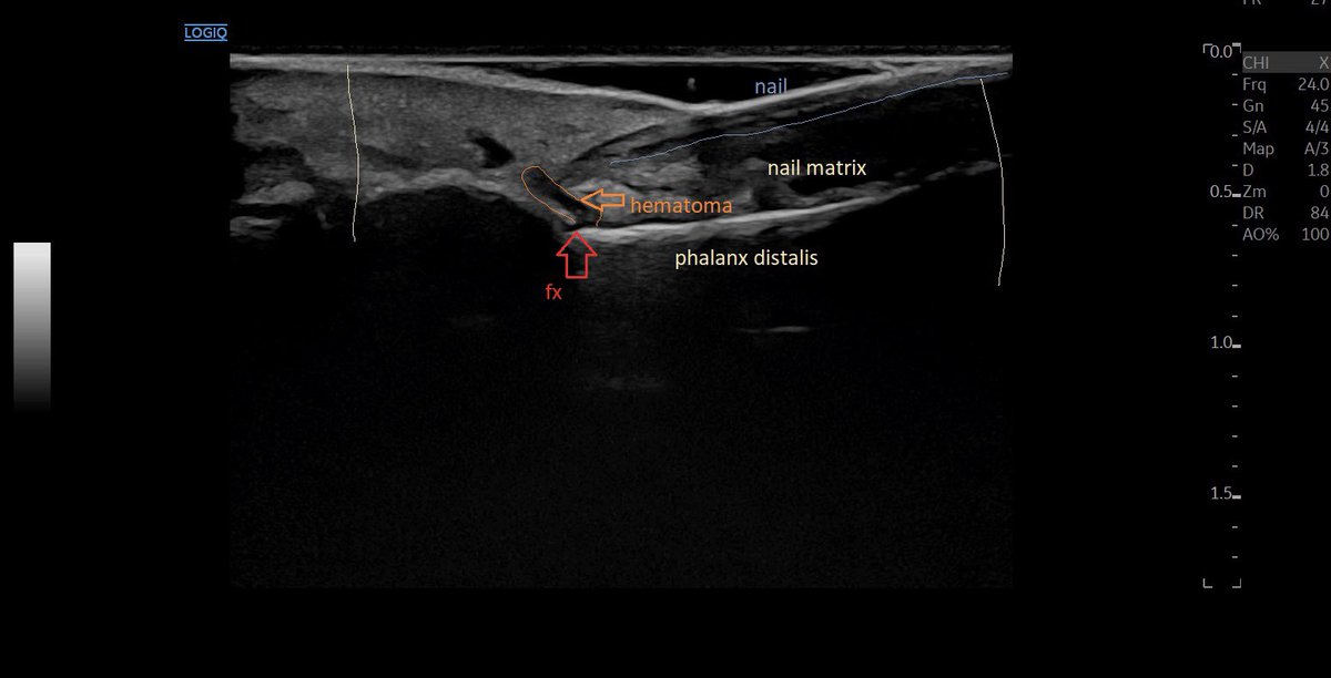 SportklinikBern's tweet photo. Not dislocated distal phalanx fracture of the big toe- better visible in #mskus #pocus #pocushub #e10r2 #toefracture #emergencyultrasound https://t.co/nSSK9pWG3N