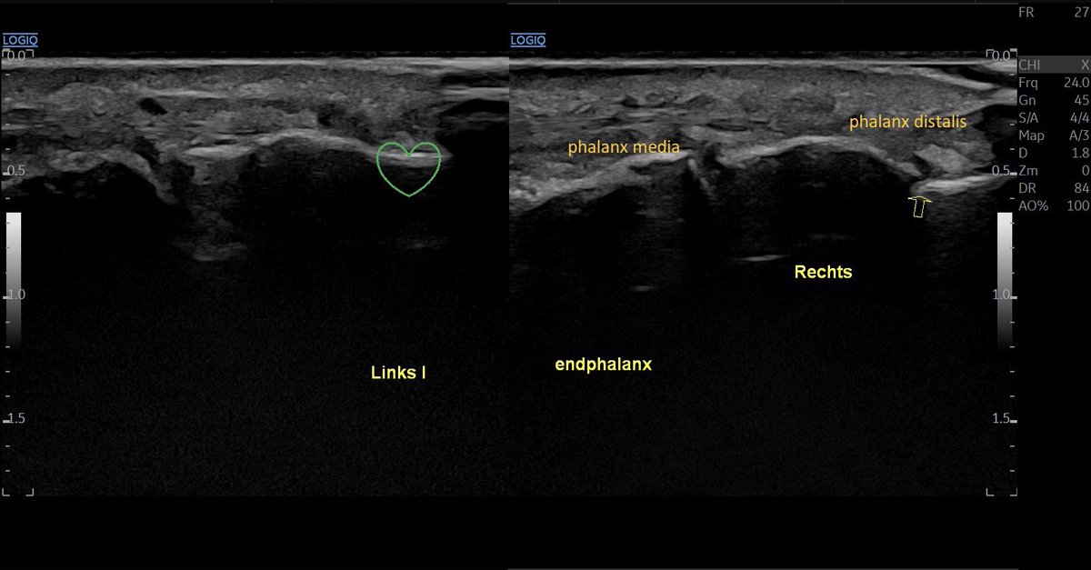 SportklinikBern's tweet photo. Not dislocated distal phalanx fracture of the big toe- better visible in #mskus #pocus #pocushub #e10r2 #toefracture #emergencyultrasound https://t.co/nSSK9pWG3N