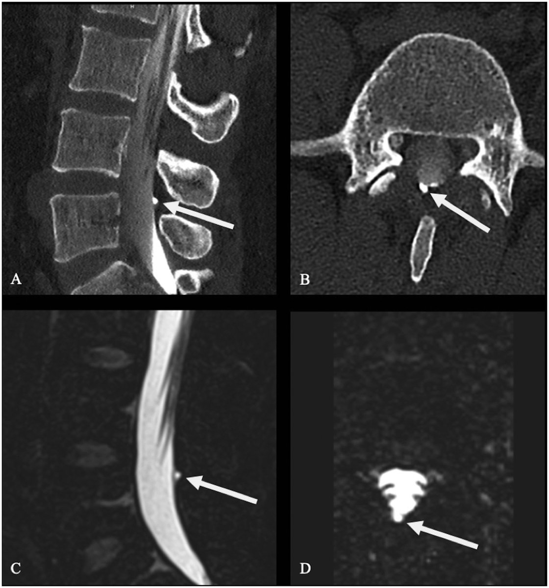J. Levi Chazen MD (@levichazen) on Twitter photo The "arachnoid bleb" - an unusual manifestation of chronic CSF leak following dural puncture: clinicalimaging.org/article/S0899-…
<a href="/MichelleRoytman/">Michelle Roytman, MD</a> <a href="/CarolinaIten/">Carolina Iten-SpinalCSFLeak Awareness Switzerland</a> <a href="/spinalCSFleak/">Spinal CSF Leak Foundation</a> #SIH #csfleak The "arachnoid bleb" - an unusual manifestation of chronic CSF leak following dural puncture: clinicalimaging.org/article/S0899-…
<a href="/MichelleRoytman/">Michelle Roytman, MD</a> <a href="/CarolinaIten/">Carolina Iten-SpinalCSFLeak Awareness Switzerland</a> <a href="/spinalCSFleak/">Spinal CSF Leak Foundation</a> #SIH #csfleak