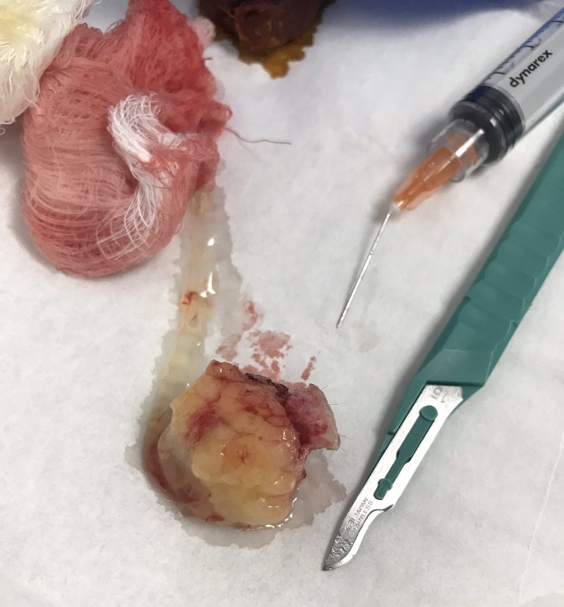 PasamTejaswi's tweet photo. 5 cystectomies in 1.5hrs. U know u r a surgeon when blood on ur hands gives u more high than caffeine. #surgery #lovetocut #adrenaline https://t.co/1qexT2906i
