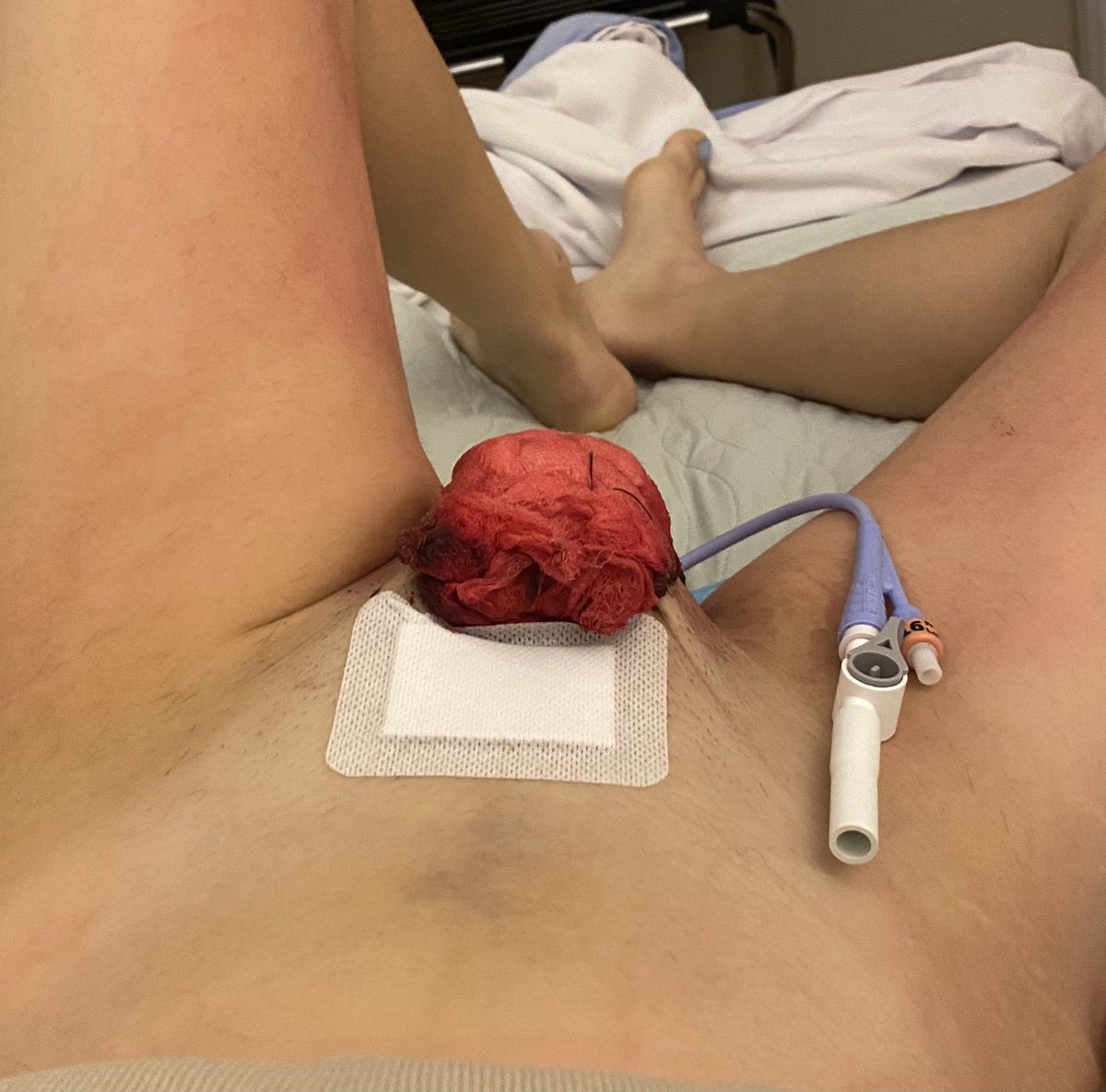 botomsurgery101's tweet photo. Tomorrow I will get my “lobster tail” (a common nickname for this bandage) taken off. GOOD BYE. But the real kicker is, I will get to see my Vagina for the first time. Granted she will still be sewn shut with a stint inside and a catheter but it’s progress! https://t.co/zY771pCIzc