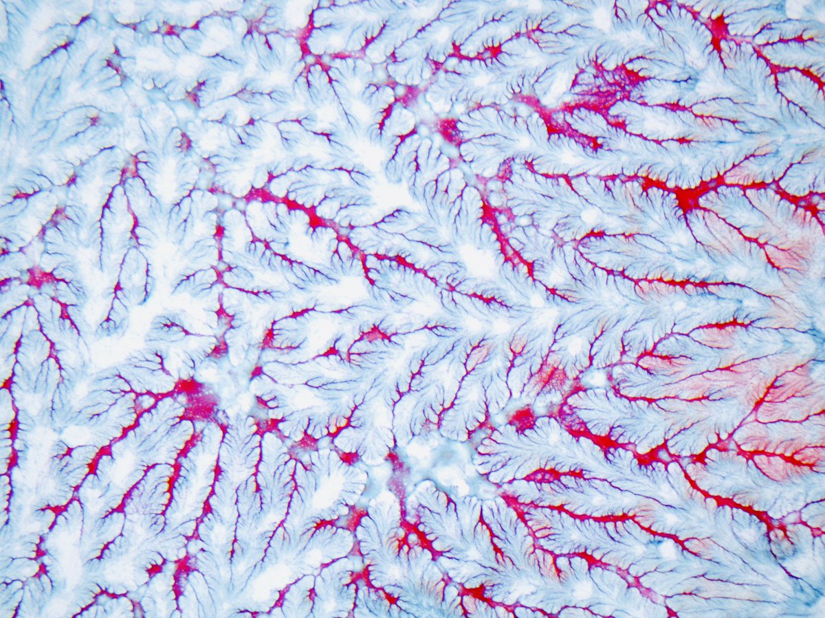 YaleCytology's tweet photo. Thyroid FNA: Ferning sign of colloid. #cytopath #cytology #PathArts https://t.co/Jaj5zQj2Ta