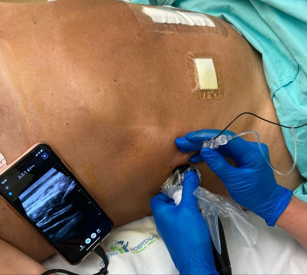 Elena Segura-Grau (@grausegura) on Twitter photo New devices, excellent quality.
Abdominal wall rescue block in PACU
<a href="/ButterflyNetInc/">Butterfly Network</a> <a href="/Barry_Pamer/">Barry Pamer</a>
#POCUS #regionalanesthesia #ultrasound New devices, excellent quality.
Abdominal wall rescue block in PACU
<a href="/ButterflyNetInc/">Butterfly Network</a> <a href="/Barry_Pamer/">Barry Pamer</a>
#POCUS #regionalanesthesia #ultrasound