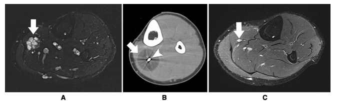 Read this #ShortCommunication from this month's issue: Percutaneous #Cryoablation of Lower Limb Soft-Tissue Venous Malformations: Preliminary Results of Long-Term Efficacy
link.springer.com/article/10.100…