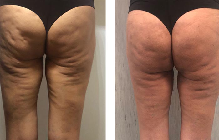 StudiofrancoM's tweet photo. L'Ozono Terapia in Medicina Estetica ed in Dermatologia...!!!
L’ozonoterapia in Medicina Estetica ed in Dermatologia avviene attraverso iniezioni sottocutanee. Lo scopo è di ridurre gli inestetismi della cellulite (pelle a buccia d’arancia, gambe gonfie, acne, ecc. ecc. https://t.co/jag6wr1vod