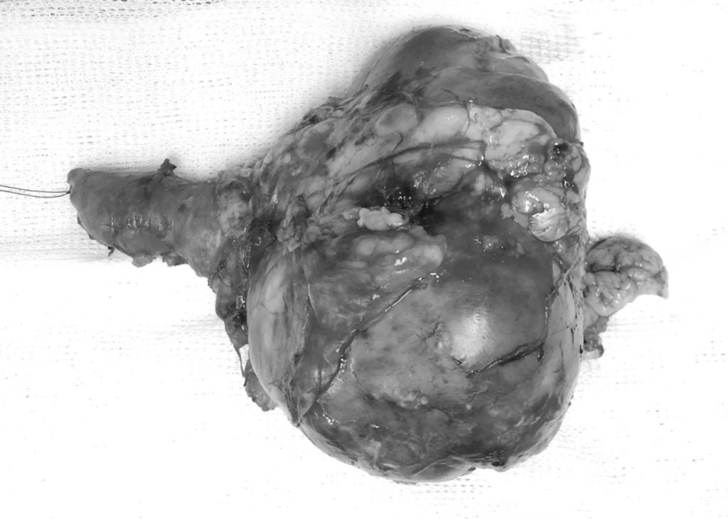 BelisleDiego's tweet photo. Nefrectomia izquierda mas reseccion de trombo tumoral a nivel del ostium de la cava 
Alta a las 72 hs, aspiracion 200 ml.  

#radicalnephrectomy #trombectomy #urooncology #UroSoMe https://t.co/WjXyd2M0vn