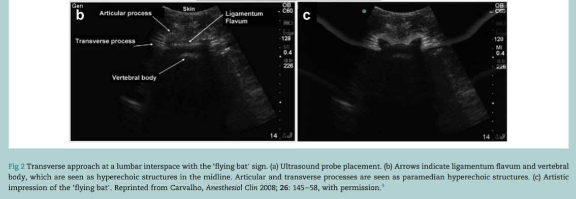 BJAJournals's tweet photo. Flying bats and saw signs...
What other terminology do you use when referring to appreciable images on US?
Our Oct #BJAEd article demonstrates how to use US to identify point of CNB puncture in Obs anaesthesia.
@josecarvalhoyyz #ObsAnaes #ObsAnes
https://t.co/dJiPQltcU7 https://t.co/pOoYJVnejv