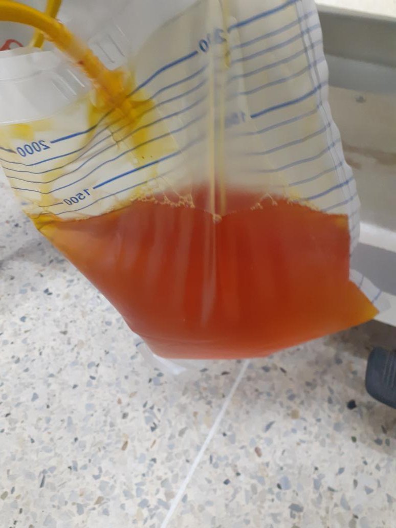 ysrndonm's tweet photo. Tenía hepatitis A. El vecino le dijo que tomará raiz de onoto que eso se lo curaba. 

Ahora pasa de tener un virus autolimitado a una falla hepática 🙂 

🗣 Si su vecino no es médico, no le haga caso si de remedios herbales se trata. https://t.co/WYrCdtElPt