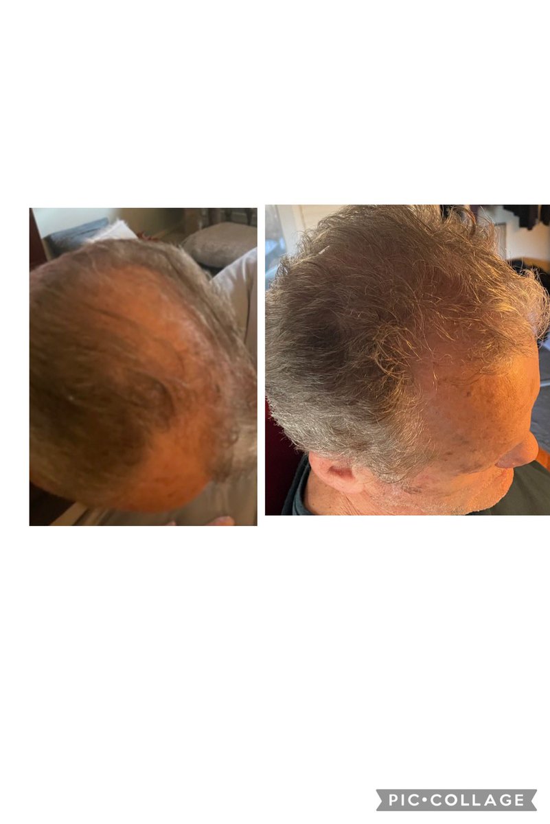 About Shane scalpmedonline.wordpress.com/about/ via <a href="/wordpressdotcom/">WordPress.com</a>  another angle. 79 yrs old. 4 months scalpmed.