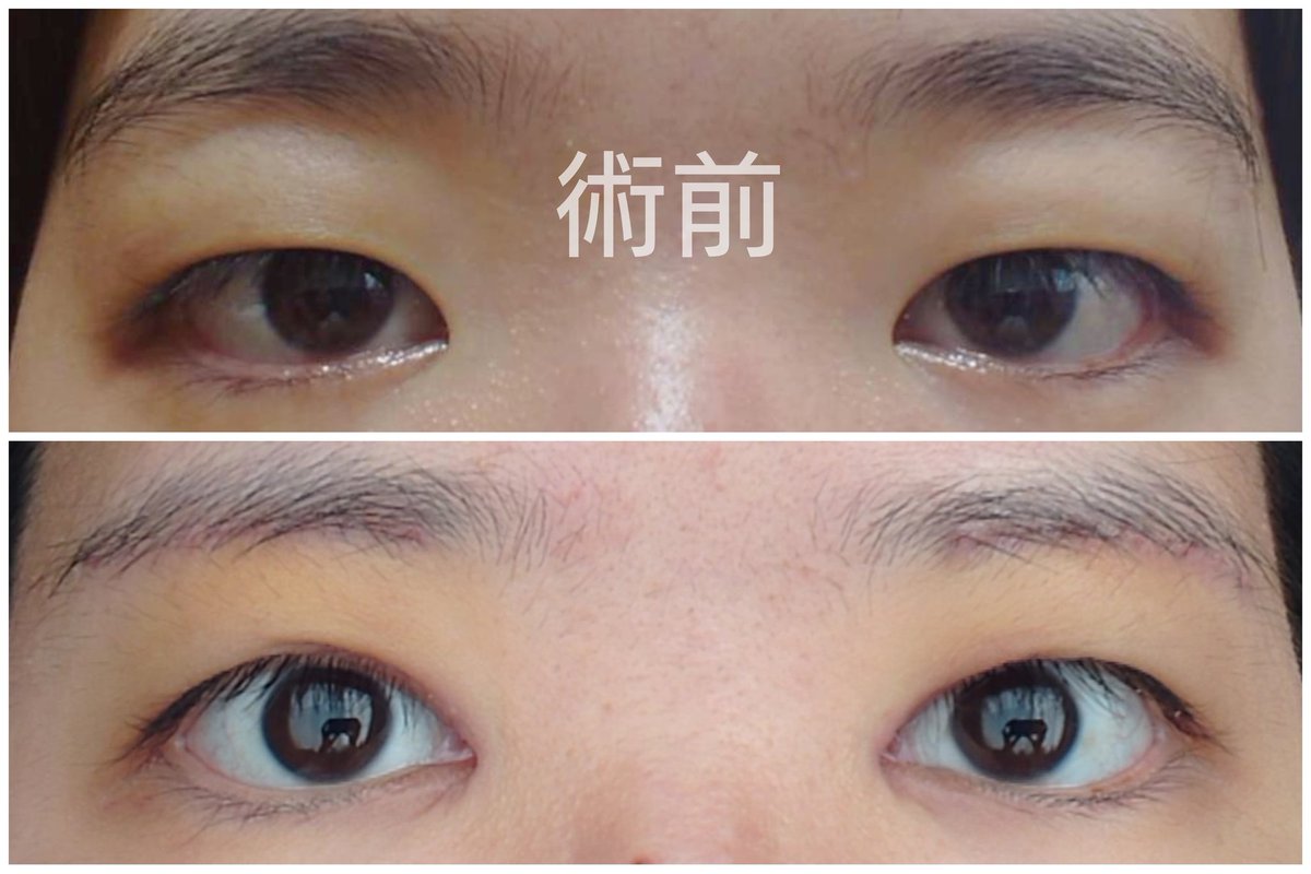 m_oilqq's tweet photo. 眉下切開と目頭切開　
8日目　抜糸の翌日
抜糸直後は赤みがひどかったですがマシになった、
離れ目なので目が寄ることなく、確実に目が大きくなってこの手術本当に自分に合ってたなと思います！
まだぼやけたり目頭の線や違和感があって不安です、、腫れもまだある、、もっと馴染め〜😣 https://t.co/WxSS6tYaGG