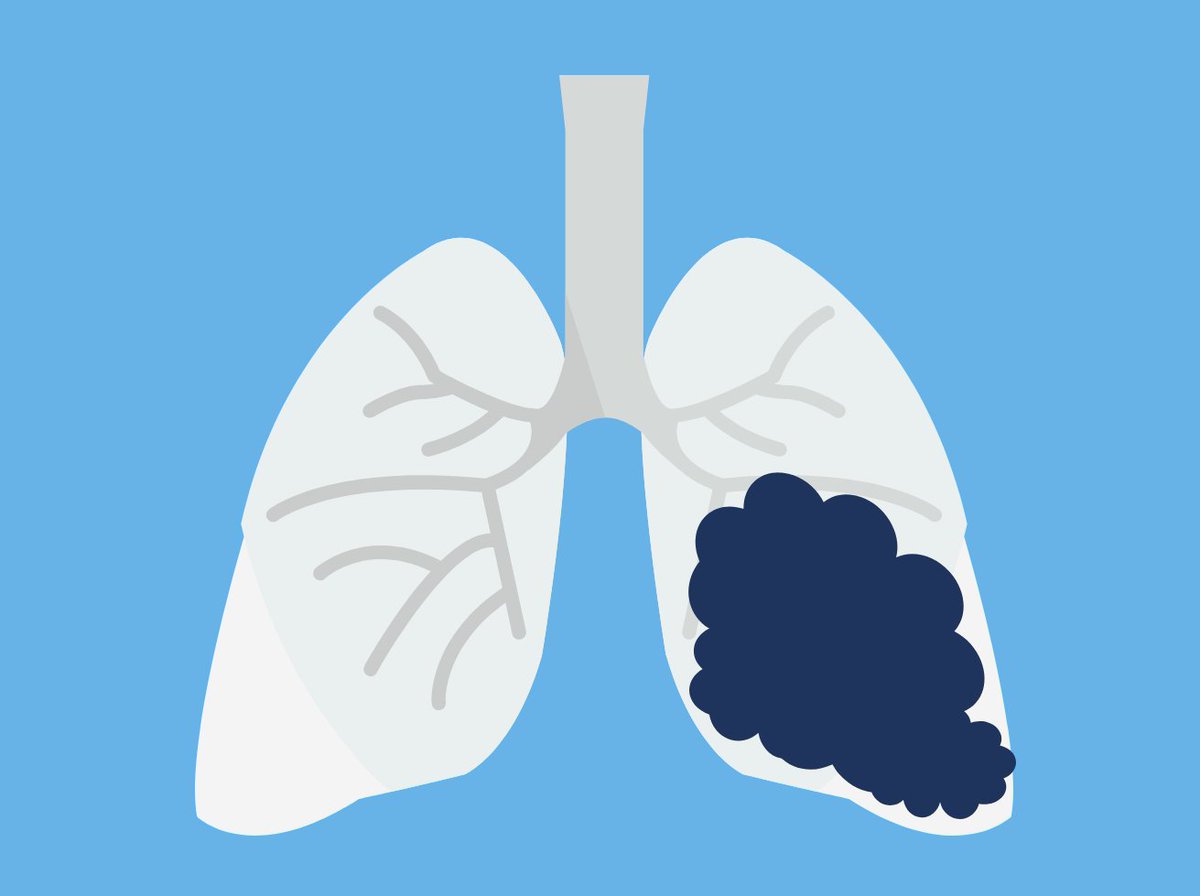 lung cancer mesothelioma and asbestosis