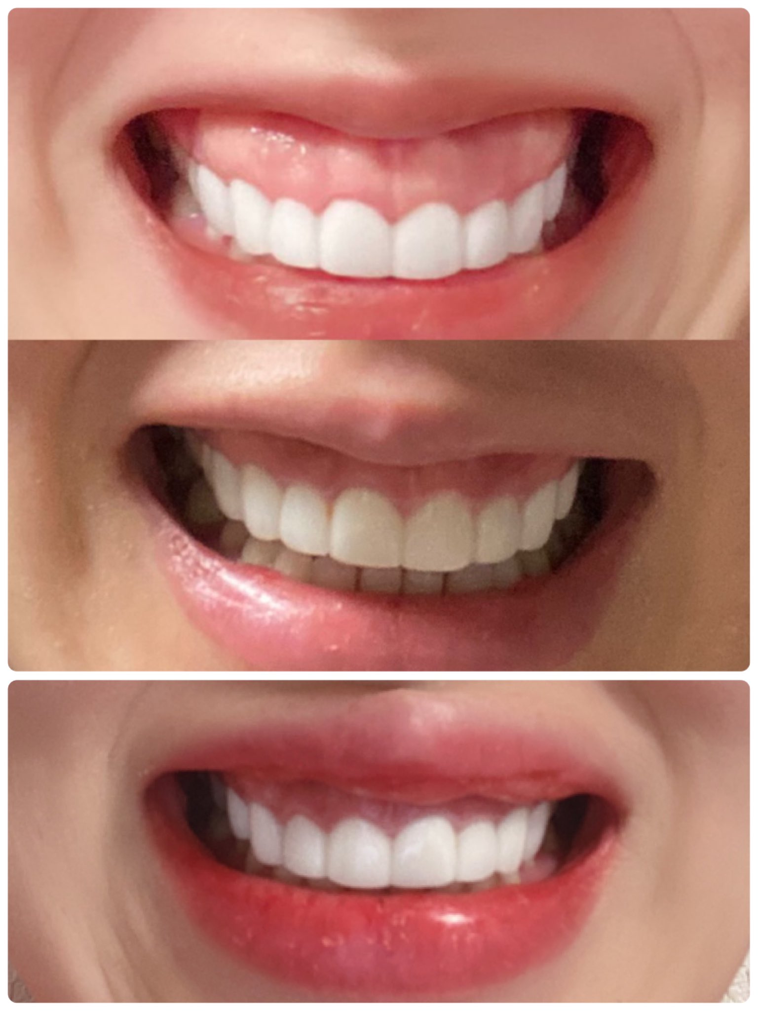 りえ 目の下脱脂dt中モティバエルゴノミクス 元ガミースマイル Yokubukariec Twitter