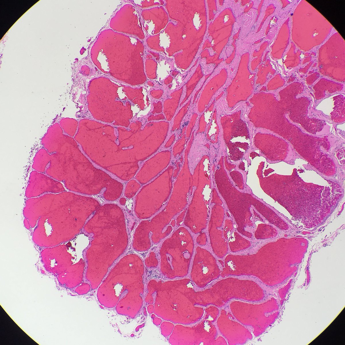 megothelioma's tweet photo. This interesting little hemangioma popped out of a patient's arm #PathTwitter #MSGPath https://t.co/OQ5OPNSvM0