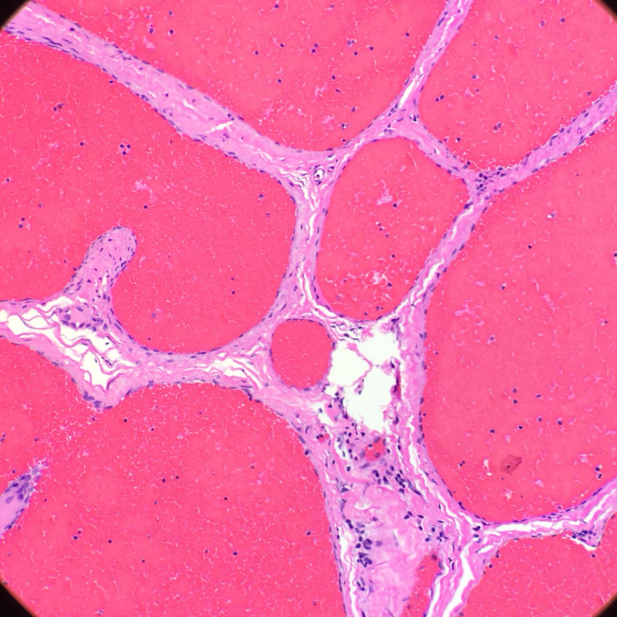 megothelioma's tweet photo. This interesting little hemangioma popped out of a patient's arm #PathTwitter #MSGPath https://t.co/OQ5OPNSvM0