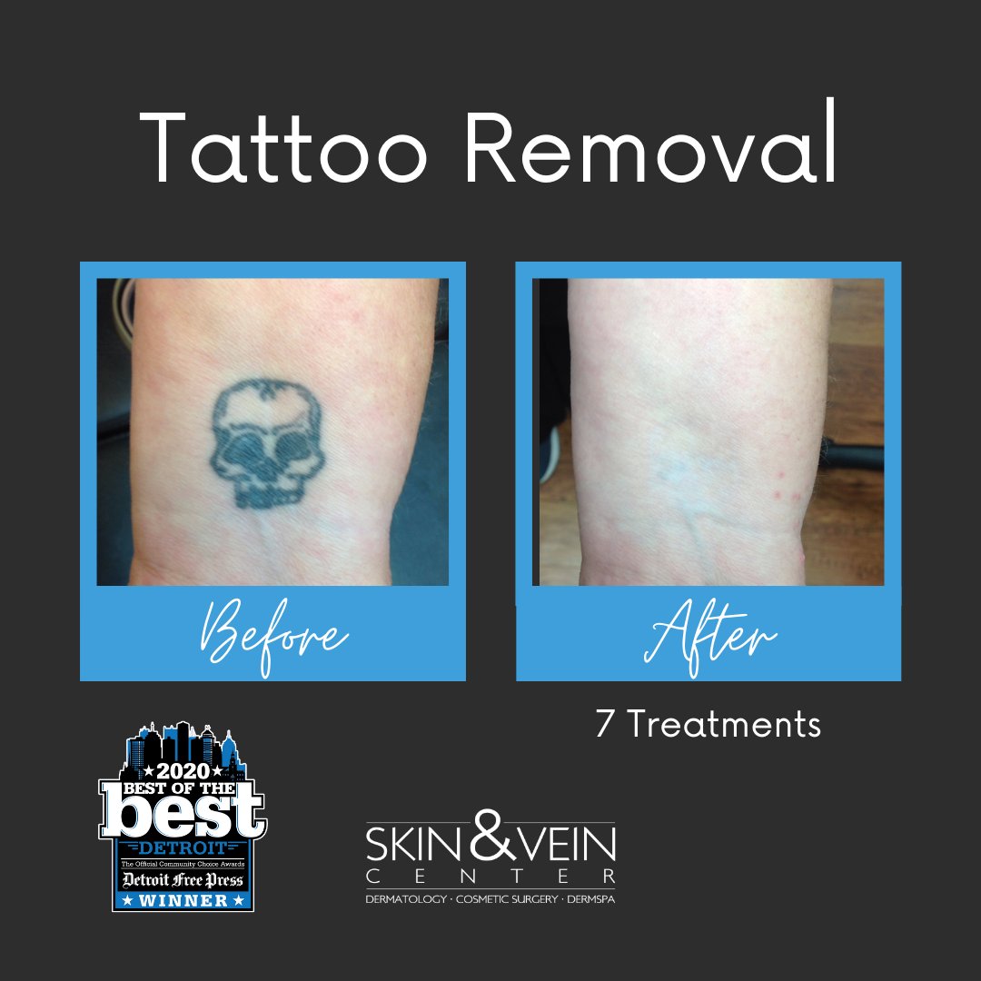 Laser Tattoo Removal Detroit  Tattoo Removal Southfield