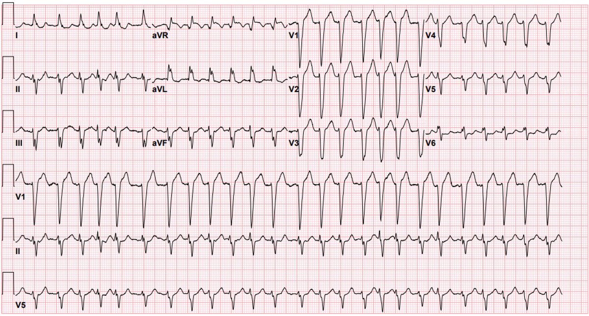 #ECGChallenge. A 90-year-old patient was noted with this rhythm on the telemetry. What are the key ECG to characterize this wide complex tachycardia? Criteria x Ventricular or supraventricular tachycardia? #EPeeps #CardioTwitter #MedEd @ecgrhythms @ECGfan @syamkumarmd @EM_RESUS
