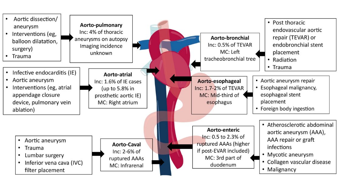 RadioGraphics's tweet photo. This article highlights the imaging algorithm and protocols in diagnosing aortic fistula, emphasizing the role of multidetector CT. Direct and indirect CT findings of various aortic fistula, potential mimickers and differential diagnoses are discussed. https://t.co/3lP8HEBvlf https://t.co/bobF9FoGLq