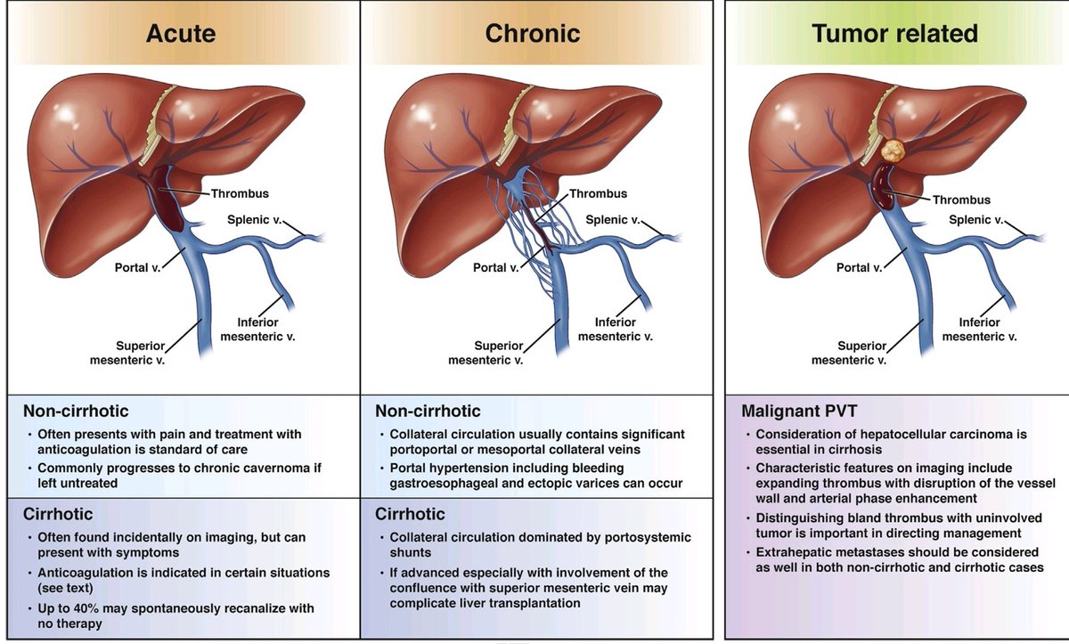 SyedGerdezi's tweet photo. Diagnosis, Development, and Treatment of Portal Vein Thrombosis in Patients With and Without Cirrhosis. 

#LiverTwitter

https://t.co/hr25Ee4ZR5 https://t.co/YowfxHOLti