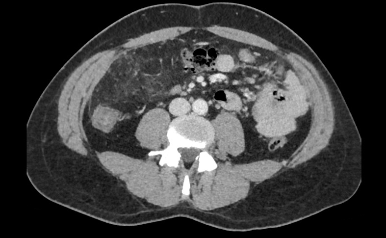 jftrebolle's tweet photo. Curioso caso de abdomen agudo secundario a infarto de epiplon por torsión del mismo. Magnífico diagnóstico radiológico @A_Rodrgz_B https://t.co/wMd81Wh5SD